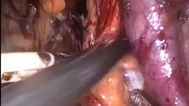 Laparoscopic pelvic lymph node dissection Лапароскопическая тазовая лимфаденэктомия смотреть онлайн