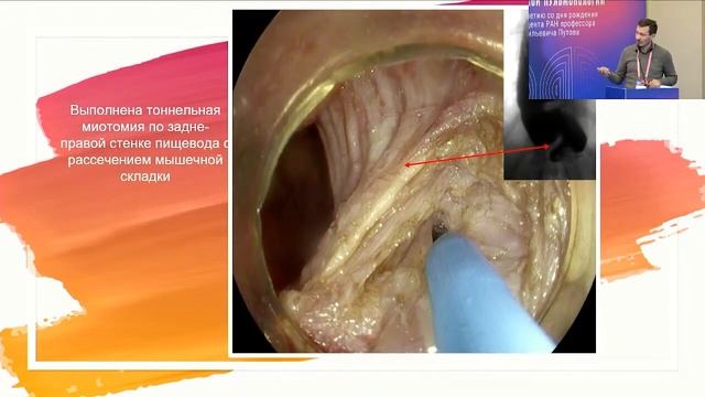 Современная диагностика и эндоскопическое лечение ахалазии кардии
