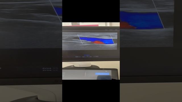 Девушке необходима операция по удалению варикоза. Флеболог Москва смотреть онлайн