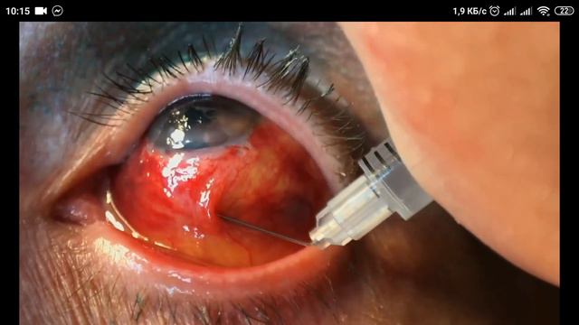 An early needling procedure after the trab 2 th day, inferior bleb смотреть онлайн