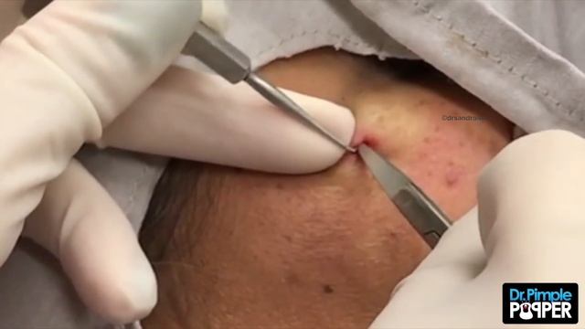 "Popping Out" a dermal piercing on the Right Cheek смотреть онлайн