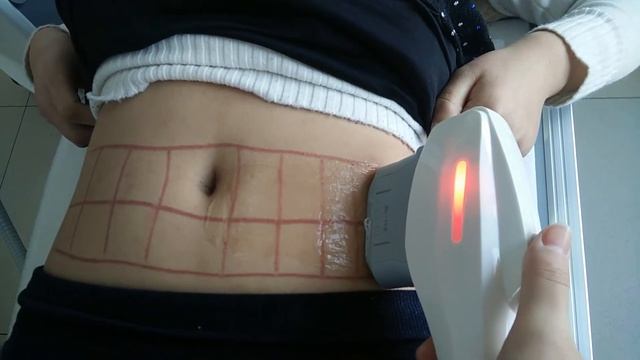 HIFU for treatment in stomach from Beijing Starlight Alice for body slimmming смотреть онлайн
