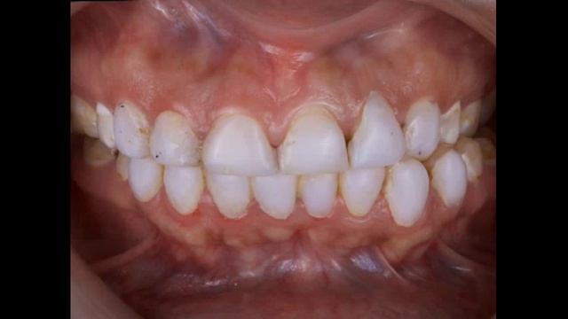 CARILLAS DENTALES DE RESINA Y PORCELANA VENTAJAS Y DESVENTAJAS