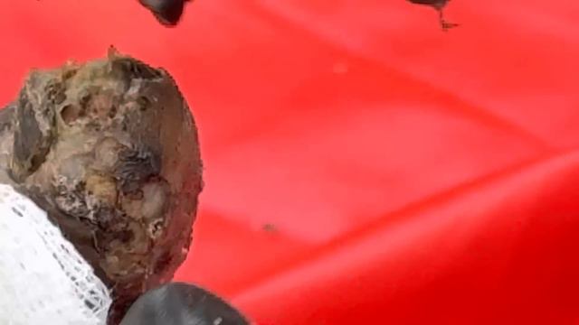 Josephine’s right foot part B - SOOO MANY JIGGERS - watch full video @riseupsociety.net смотреть онлайн