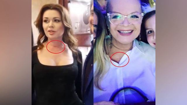 Повторение судьбы Заворотнюк! Страшная отметина на шее Долиной напугала всех. Все плохо смотреть онлайн