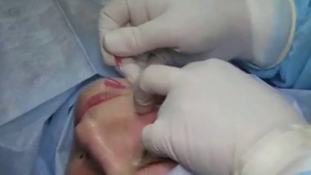 Постановка мезонитей. Работа пластического хирурга Карповой Е.И. смотреть онлайн