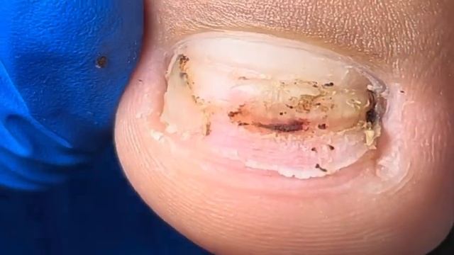 Bad nails are bruised! Gentle pedicure【Xue Yidao】 смотреть онлайн