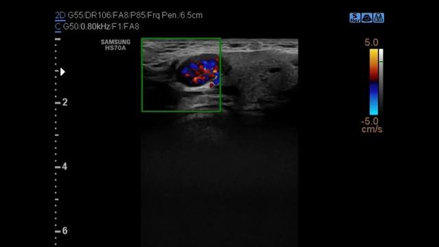 VASCULAR NODE OR ANGIOFIBROMA AT LEFT SUBMANDIBULAR REGION смотреть онлайн