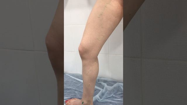 Результат после операции лечения варикоза. Как лечить варикоз? Флеболог Москва смотреть онлайн