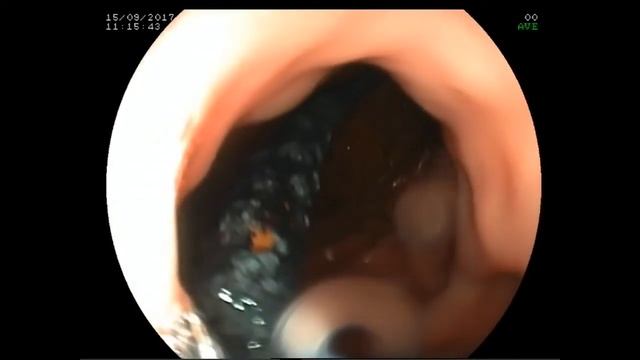 В Бурятии женщина прожила 17 лет с зондом в желудке смотреть онлайн