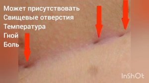 Шишка возле копчика. Шишка между ягодиц. Эпителиальный копчиковый ход. Киста копчика.