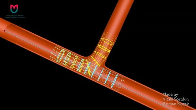 Бифуркационное стентирование коронарных артерий/ bifurcation PCI