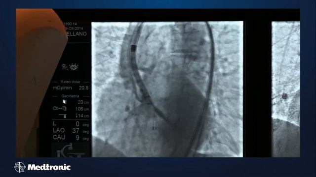 CoreValv Evolut R by Dott. Arturo Giordano смотреть онлайн