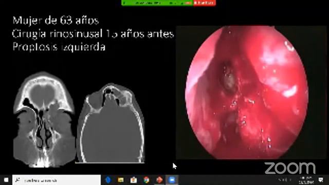 Webinar Seno Frontal - ORLHIBA смотреть онлайн