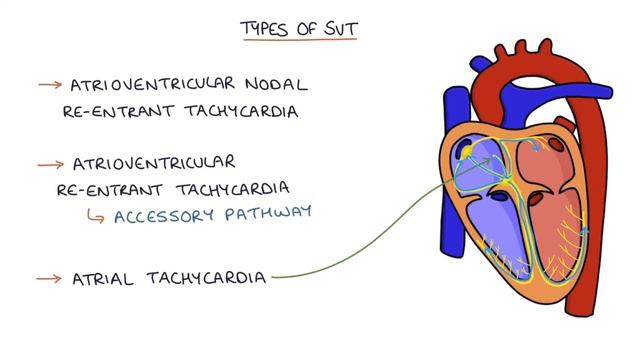 Understanding Supraventricular Tachycardia (SVT)