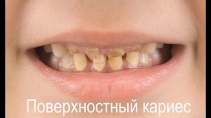 Бутылочный кариес у детей