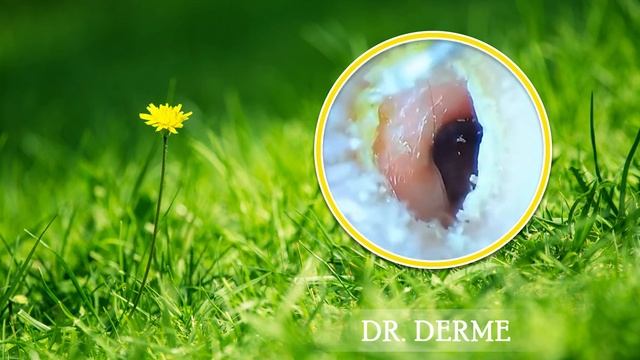 Удалите огромные блоки ушной серы | Ear War Block Removal