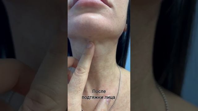 Рубцы после платизмопластики смотреть онлайн