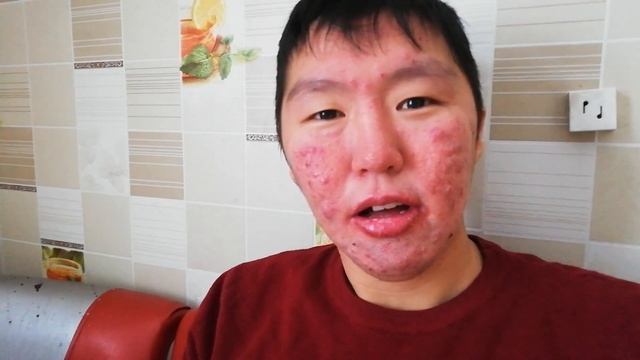 Лечим прыщ , Акне,!Роаккутан! 18 день!кровь из носа!новый телефон еще один плюс отказ от Алкоголя=) смотреть онлайн