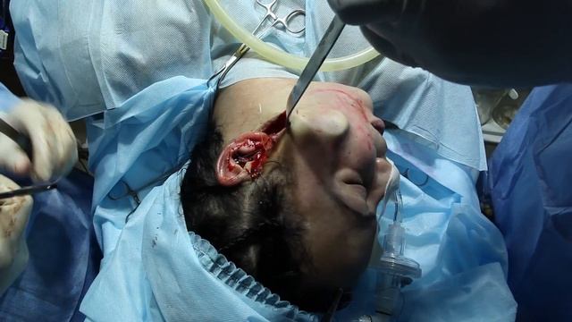 SMAS FACE LIFT. МЕТОДИКА ОПЕРАТИВНОГО ВМЕШАТЕЛЬСТВА смотреть онлайн