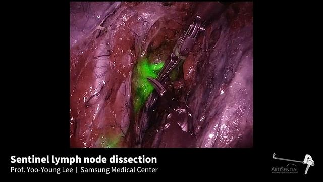 Sentinel lymph node dissection - Prof. Yoo-Young Lee смотреть онлайн