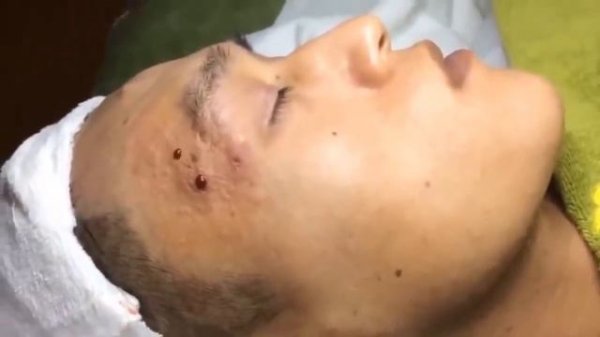 ОГРОМНЫЙ ЧИРИЙ НА ВИСКЕ У ПАРНЯ!!!! ГНОЙНОЕ СКОПЛЕНИЕ В ОГРОМНОМ РАЗМЕРЕ!