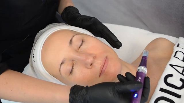 MEDICARE Антиоксидантный мезопилинг. Протокол процедуры.