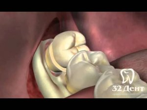 Удаление зуба мудрости