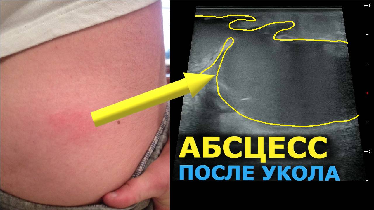 Как выглядит Постинъекционный Абсцесс на УЗИ? смотреть онлайн