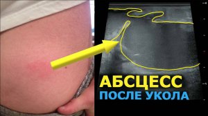 Как выглядит Постинъекционный Абсцесс на УЗИ?