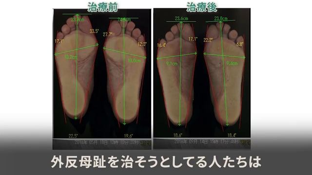 外反母趾や様々な足の疾患が、なぜ歩き方で治ると私は言えるのか　その裏付け等を解説 смотреть онлайн
