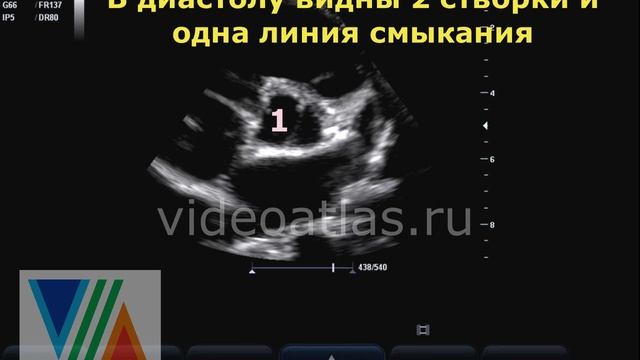 Двустворчатый АК (истинный) (ещё один пример) смотреть онлайн