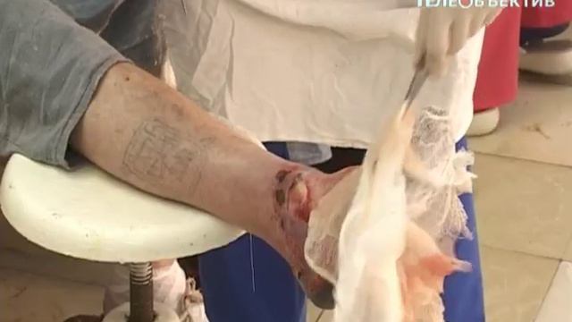 Обморожение