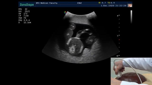 УЗИ плода во втором триместре. Практическое занятие на фантоме. смотреть онлайн