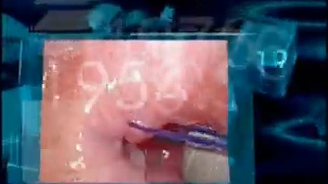 The Endoscopy Evolution смотреть онлайн