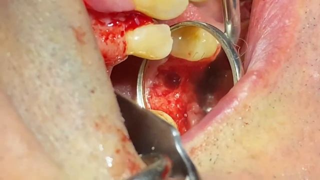 CRESTAL SINUS LIFT ACCESS смотреть онлайн