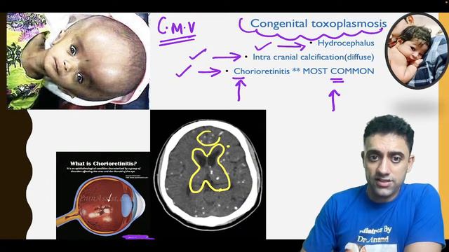 CNS PART 8 By Dr.Anand смотреть онлайн