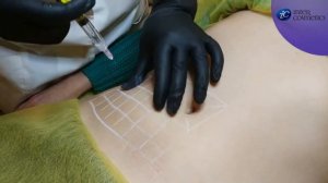 Протокол введения непрямого липолитика на тело