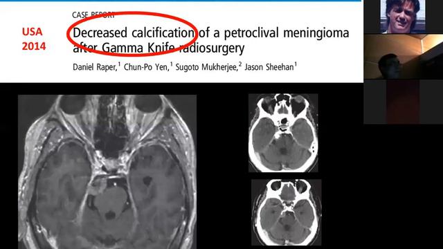 Petroclival Meningioma - Sbeih смотреть онлайн