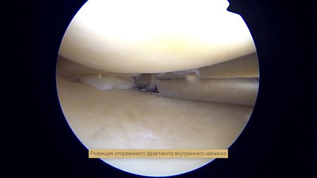 Резекция внутреннего мениска при разрыве «ручка лейки» смотреть онлайн