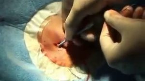 Катетеризация подключичной вены