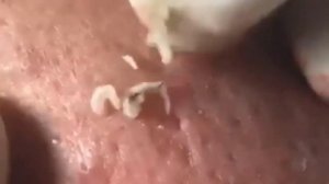 Выдавливание Прыщей   выдавливание черных точек. मुँहासे निचोड़ने वाले ब्लैक डॉट्स को निचोड़ना