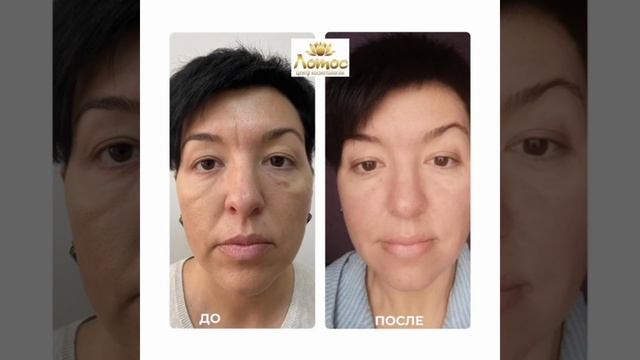 Лазерное омоложение смотреть онлайн