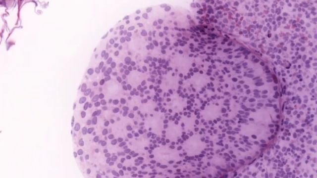 OTLS3 20X axillary lymph node O1-flip ENE смотреть онлайн
