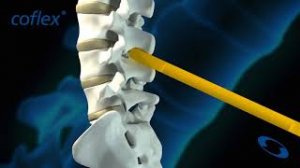 Coflex  - межостистый фиксатор. Устанавливается для разгрузки смежных сегментов пдс.