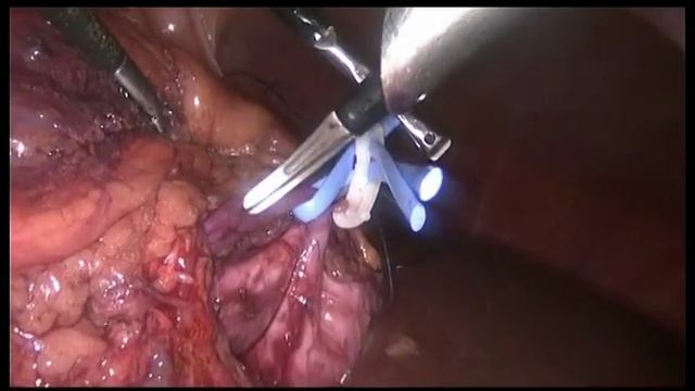 Лапароскопическая пластика лоханочно-мочеточникового сегмента смотреть онлайн