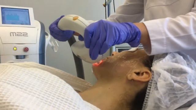Термолифтинг на аппарате М22 смотреть онлайн