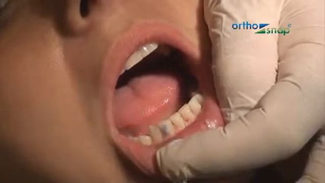 Активаторы ОртоСнэп - установка активаторов смотреть онлайн