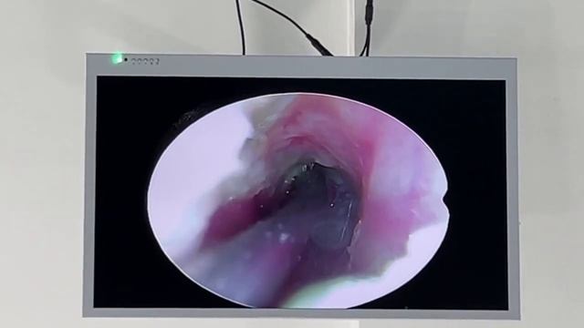 ЛОР в Хуньчуне / Чистка ушей / Слабонервным не смотреть