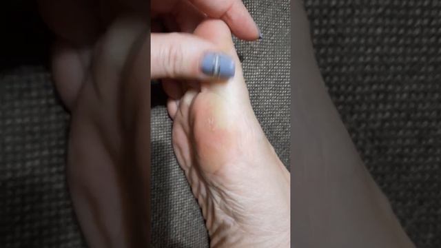 Ступневая Мозоль.как с ней бороться смотреть онлайн